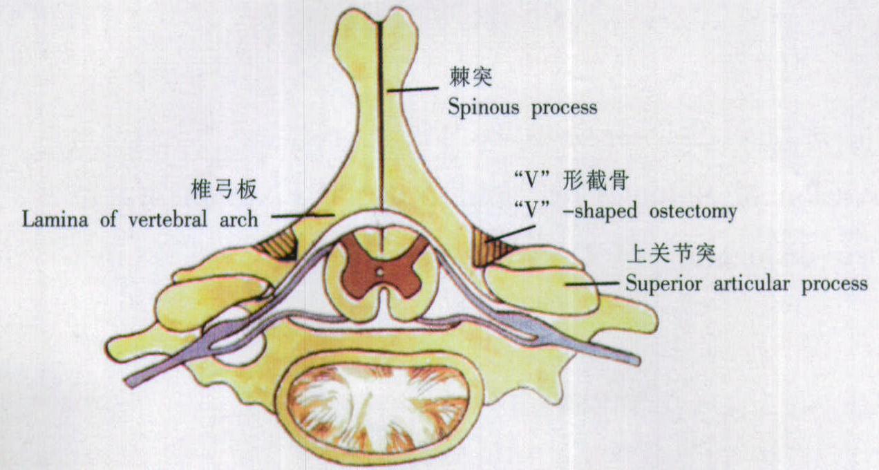 颈椎后路减压及椎管扩大成形术
